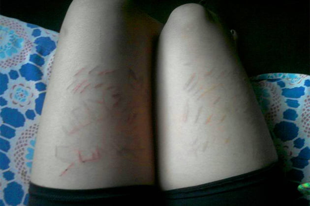 Emo Teens Deal Depression with ‘Cutting’ Emo Teens Deal Depression with ‘Cutting’