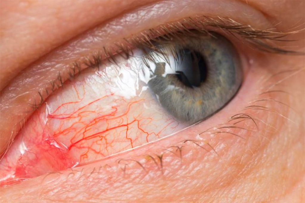 HEALTH ADVISORY - Increase in “Pink Eye” cases in Neighboring Quintana Roo 8