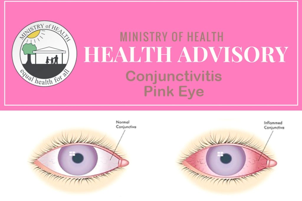 Pink Eye Outbreak in Belize is Pretty Bad 28