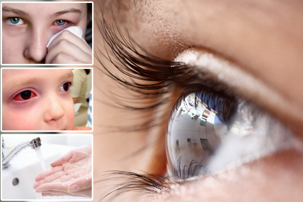 Pink Eye is Not Over Yet - Worst Outbreak in Belize History 22