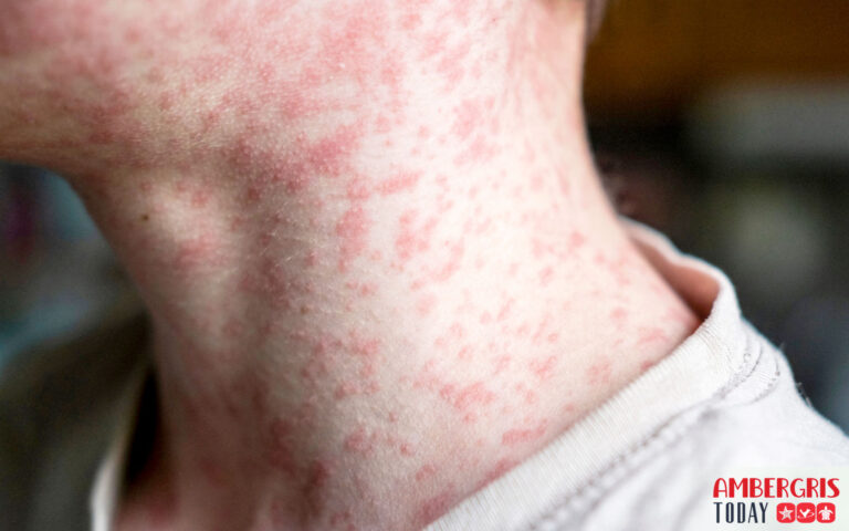 two measles cases in Belize