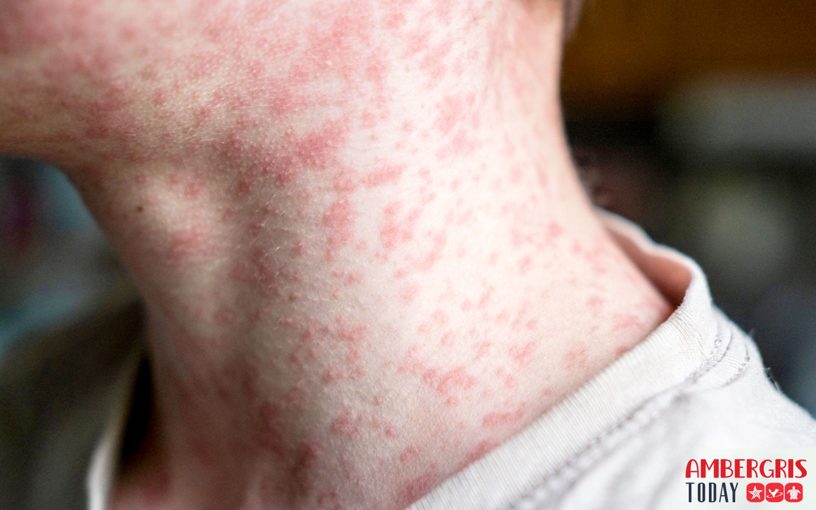 two measles cases in Belize
